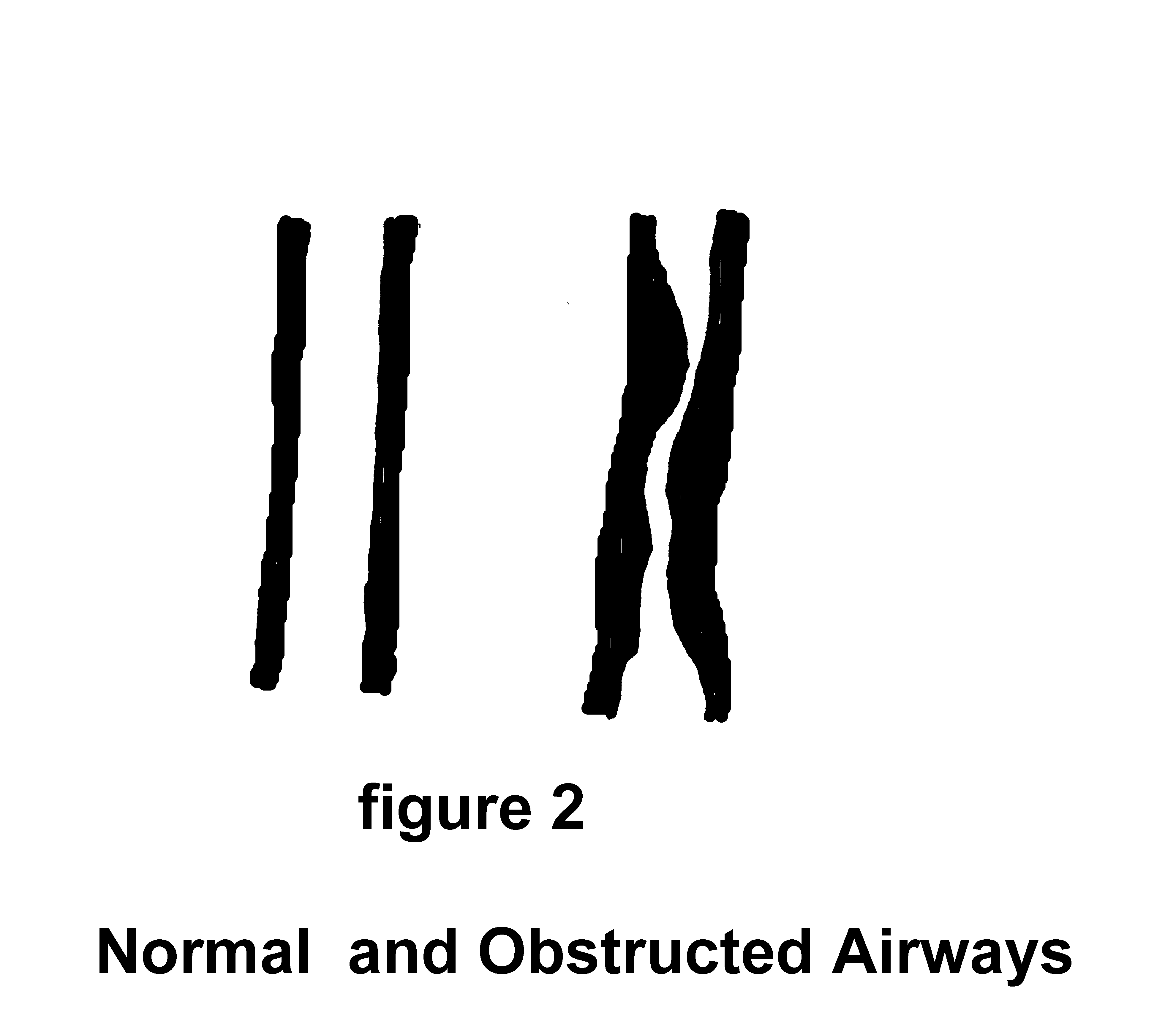 picture of Normal and Obstructed Airways - Quit Smoking - The SMOKING CESSATION CLINIC